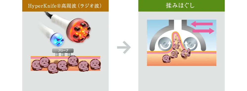 HyperKnife&reg;高周波（ラジオ波）からの揉みほぐし